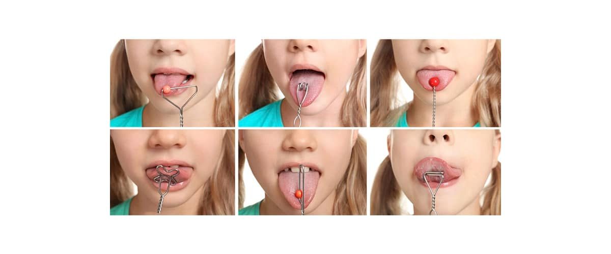 Terapia-Miofuncional-Orofacial